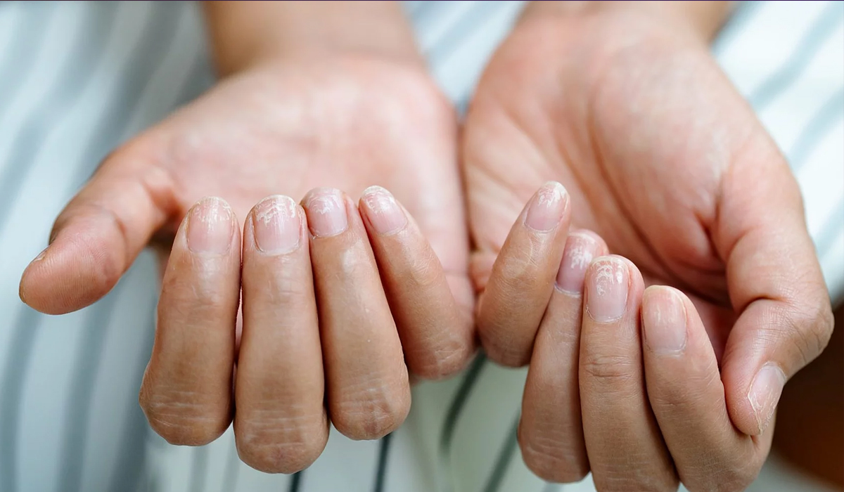 The Moons on Your Nails Can Warn You About These 13 Problems